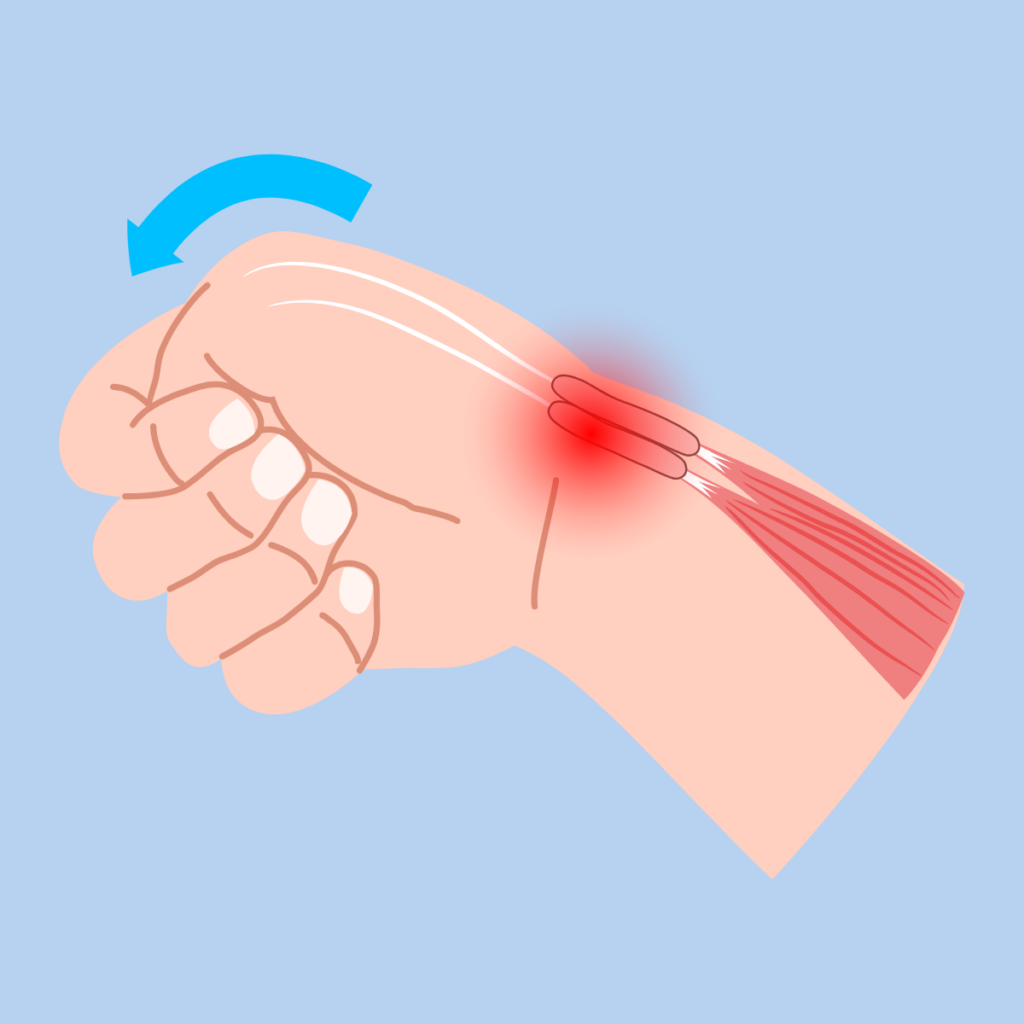 Is Your Phone Causing Thumb or Wrist Pain? Common Conditions and How to Manage Them | Action Rehab - Shoulder, Elbow, Wrist and Hand Physiotherapists Is Your Phone Causing Thumb or Wrist Pain? Common Conditions and How to Manage Them | Action Rehab - Shoulder, Elbow, Wrist and Hand Physiotherapists