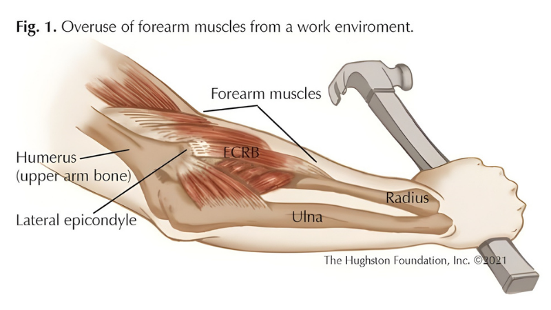 How can I have Tennis Elbow if I don’t play Tennis? | Action Rehab - Shoulder, Elbow, Wrist and Hand Physiotherapists How can I have Tennis Elbow if I don’t play Tennis? | Action Rehab - Shoulder, Elbow, Wrist and Hand Physiotherapists