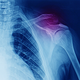 Acromioclavicular-Joint-AC-Joint-Injury