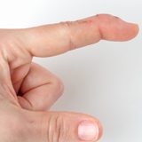 Mallet Finger Treatment Mallet Finger Treatment | Action Rehab